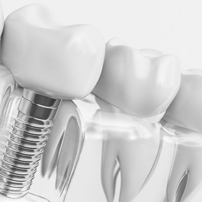 dis-implanti-nedir-nasil-takilir